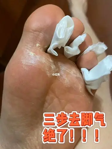 网上学到的去脚气方法