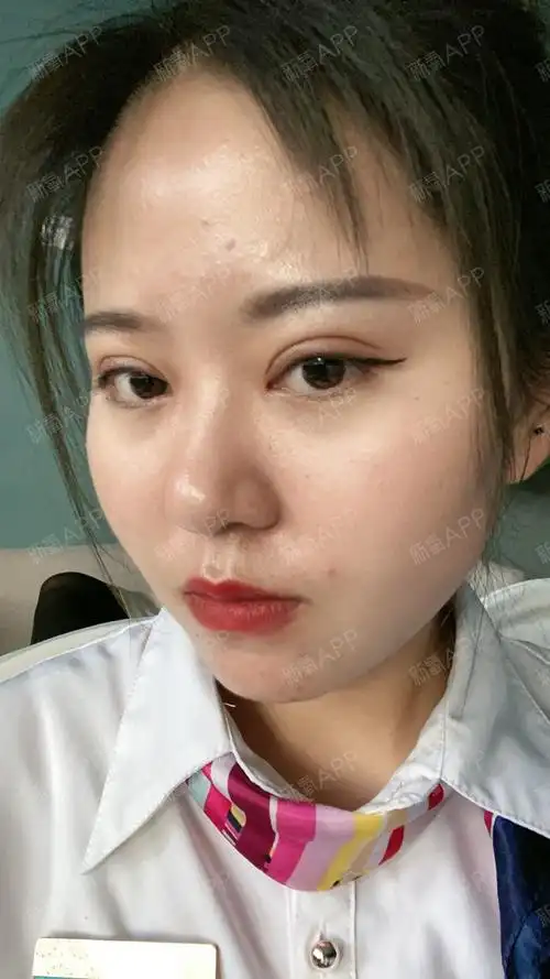 艺星美杜莎双眼皮术后30天】做完双眼皮已经一个月_圈子-新氧美容整形