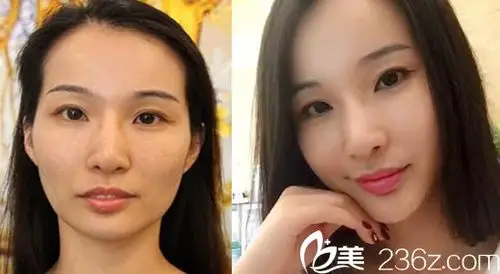 自体脂肪全脸填充案例对比图