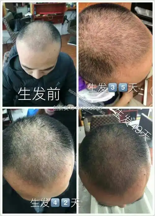 顶峰白转黑,生发 - 美篇