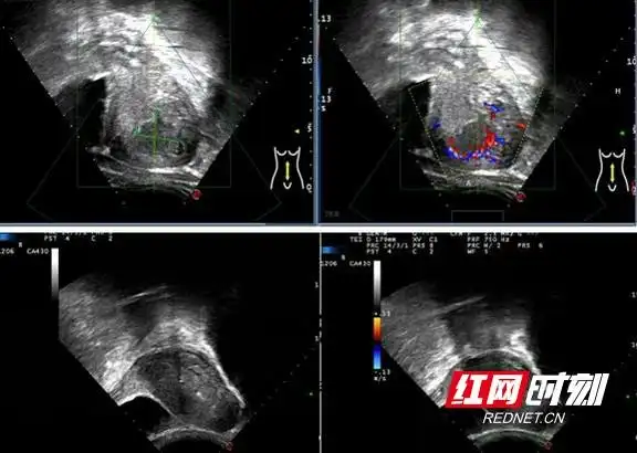 岳阳市妇幼保健院海扶刀成功治疗胎盘植入