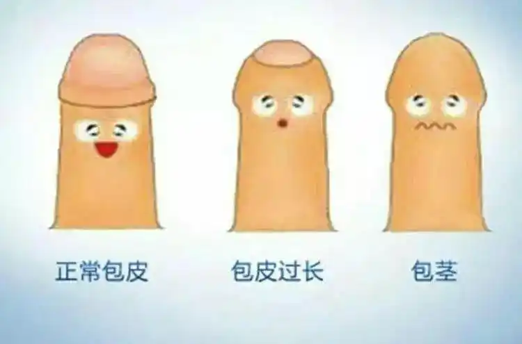 *正常小儿包皮和病理性包皮过长,包茎对比图