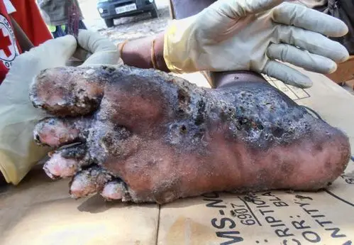 世界上十大最恶心的寄生虫非常恶心恐怖