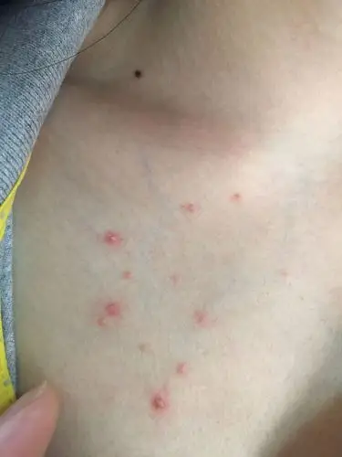 这几天胸口突然长了好多这样一粒粒的,请问大神们我这是怎么了?