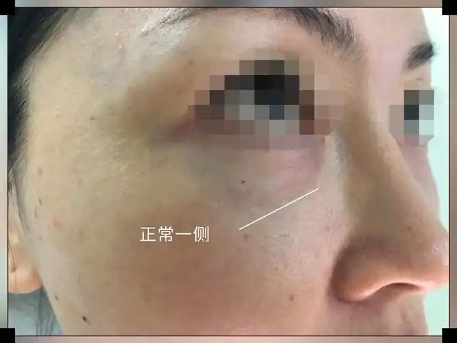 泪沟填充失败案例来一组