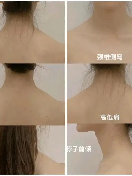 改善斜方肌对我这个真的有用吗?已经练了30多天了,_圈子-新氧美容整形