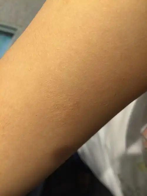 皮肤局部有褶皱是什么原因导致的?