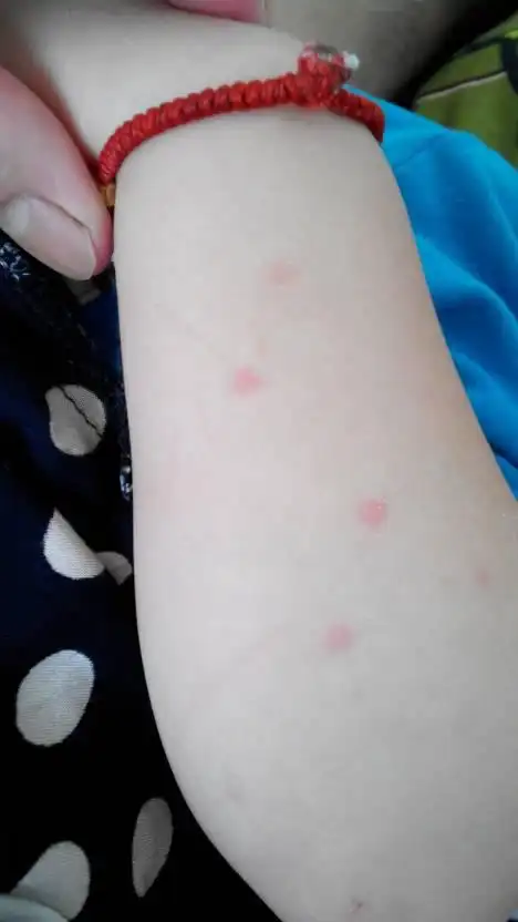 男,两岁,手足侧,臀部,小腿,舌尖出现针尖小水痘,无不适症状!