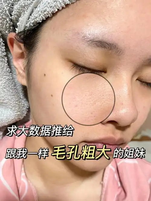 女大学生毛孔粗大自救笔记