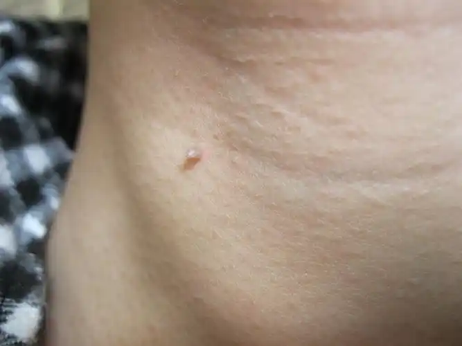 脖子上长了这么个东西,请教大家一下这是什么,为什么会长啊,需要注意