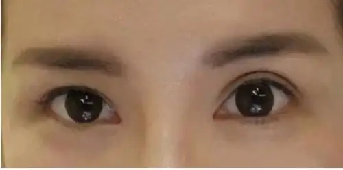 双眼皮三大失败形态修复讲解,比起初次简直就是巨难!