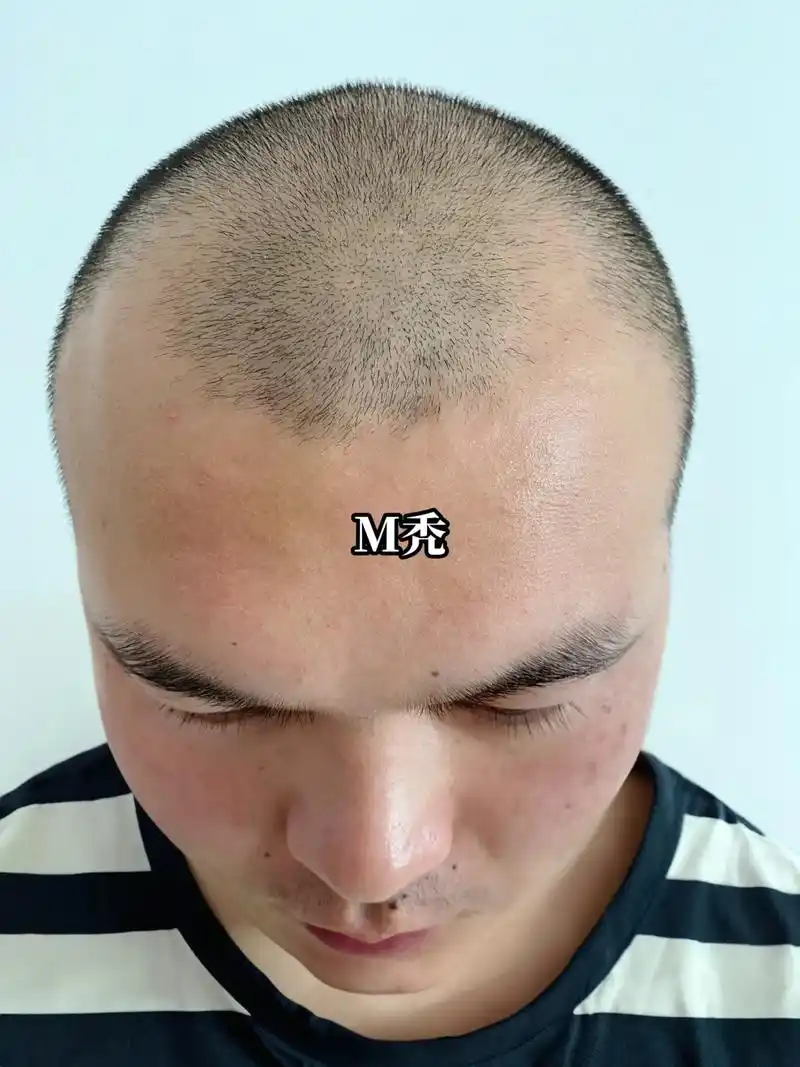 m型全秃,发际线设计,浓密小寸头.发际线一变,快乐一大片#拯 - 抖音
