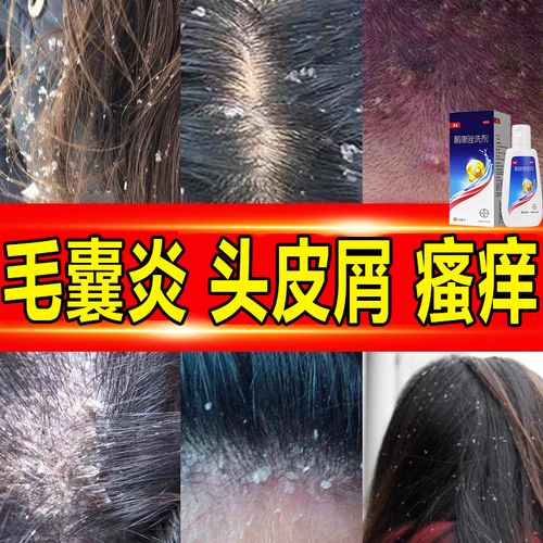 头痒真菌头皮屑多毛囊炎头部【成人专用】药康王洗发水去屑止痒皮炎