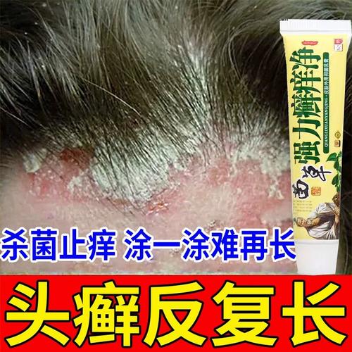 治疗头癣毛囊炎专用头部头皮痒有疙瘩后脑勺手臂背上长痘痘特效药