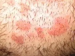 外阴皮肤脂溢性皮炎