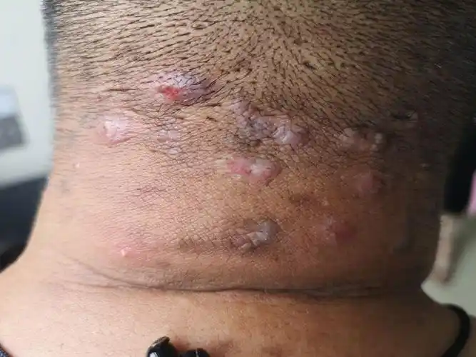 难缠的疤痕疙瘩性毛囊炎-朱敏刚主任医师-爱问医生