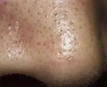 出油型毛孔粗大拯救计划##夏日护肤大作战##控油秘诀##收缩毛孔