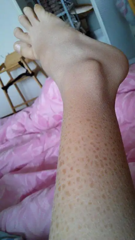 幼儿,女,皮肤粗糙,鳞状,不疼不痒,热水