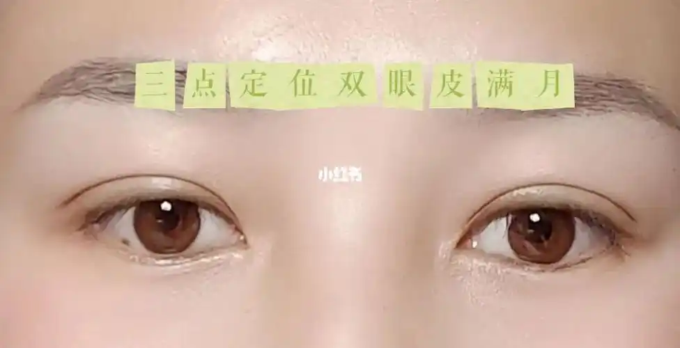 三点定位双眼皮满月啦