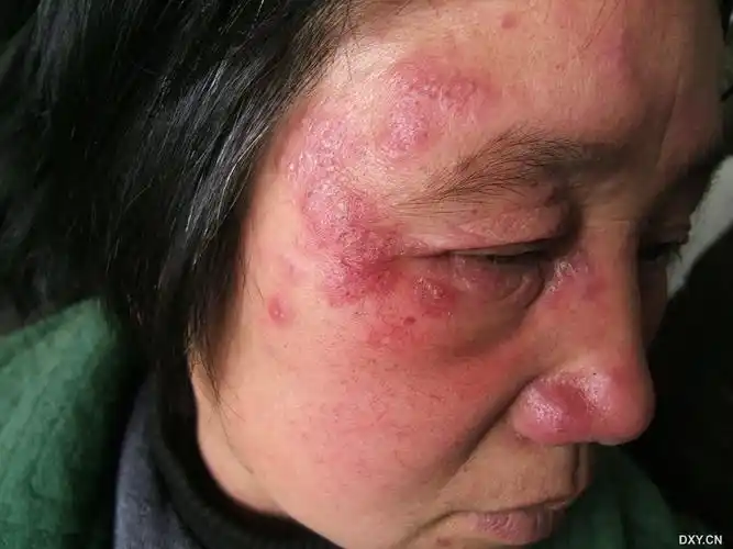 【请教】这样的面部红斑该如何诊断 - 皮肤与性传播疾病讨论版