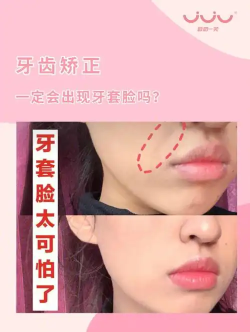 牙齿矫正矫正一定会变成牙套脸吗