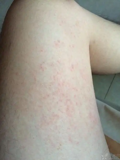 是不是秋裤过敏 - 皮肤性病 -丁香园论坛