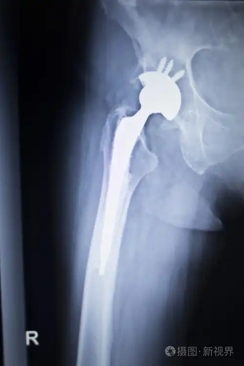 髋关节置换骨科植入物的 x 射线扫描图像