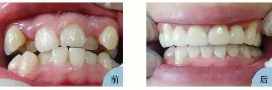 龅牙有什么危害?