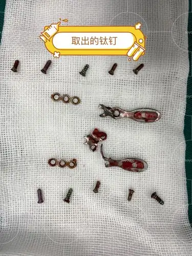 姑娘第一次3年前做的颧骨下颌角手术,效果并不理想,_圈子-新氧美容整