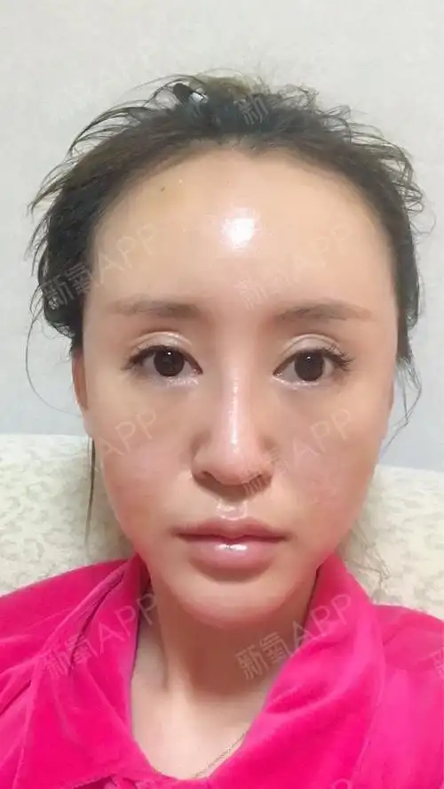 张张张颖自体脂肪全脸填充第3天美丽日记