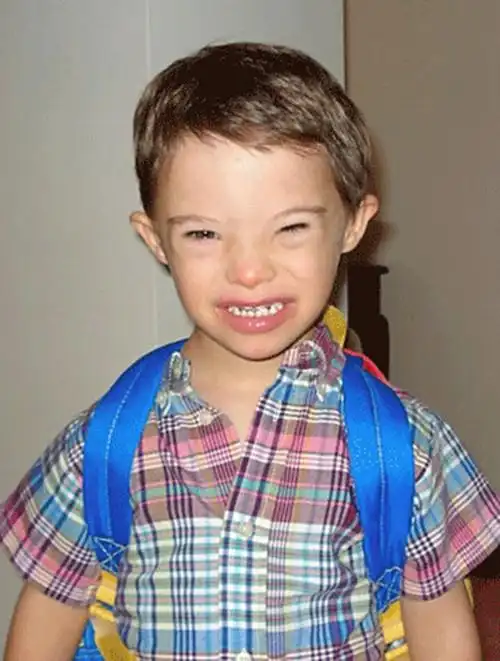 唐氏综合症特征图片_有来医生