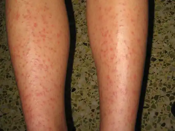 季节性皮肤病是一种季节性反复发作,由花粉等引起的一种接触性皮