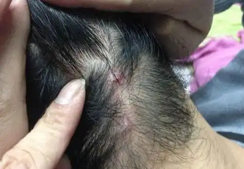 头皮长出红色小疙瘩,其实是毛囊炎痘痘,别轻视,严重会造成脱发