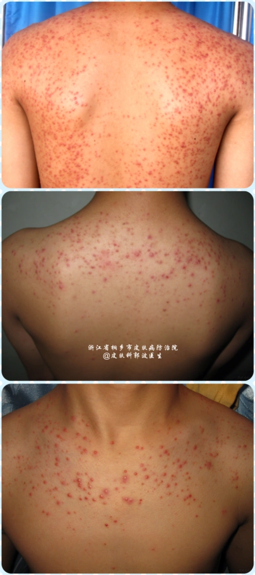 毛囊炎_传染_预防_治疗方法_介绍_如何预防_治疗方式 - 好大夫韵哌