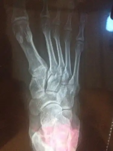 右脚的第二根脚趾骨头痛.大概一个月了.摔过一次.走路走多了就疼.