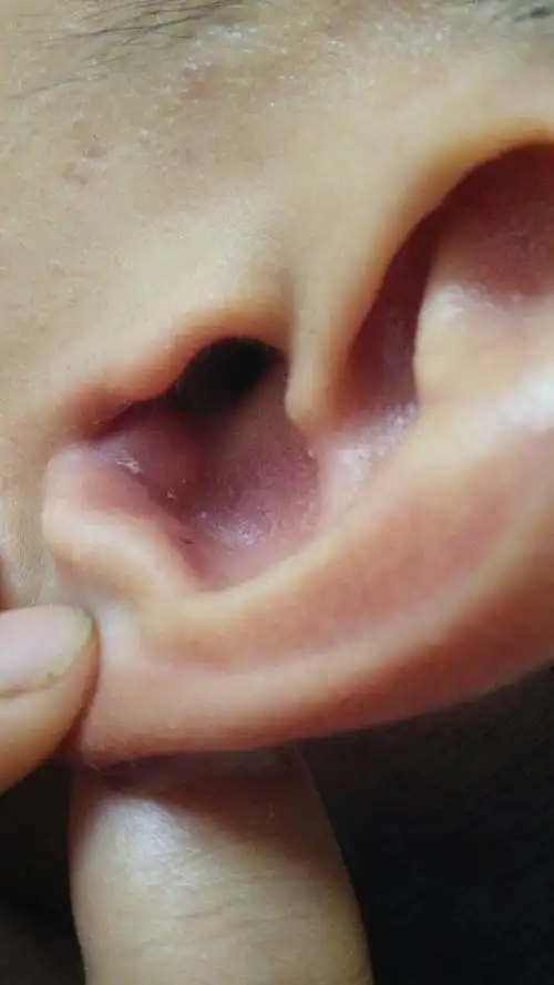 耳朵长个大疙瘩,是怎么了?