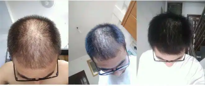 北方的孤狼:30岁开始脱发,头皮上都没有几根头发了,老婆在网上买涤