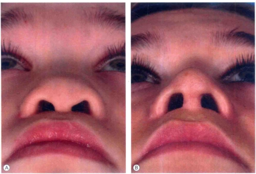 9(a)基底面中显示,binder综合征患者严重的变形鼻孔;(b)术后照片.