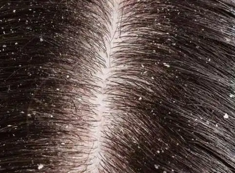 头屑一片一片的像结痂一样,天天洗头都没用,应该怎么办才好_头皮