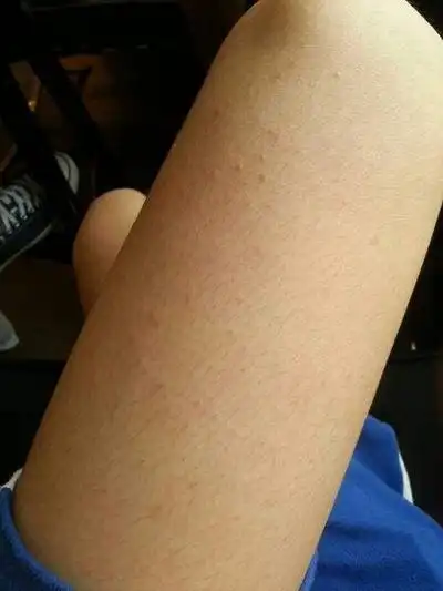 艾滋病急性期皮疹特点有哪些呢更新时间:2022-10-19-精准抗艾-互联网