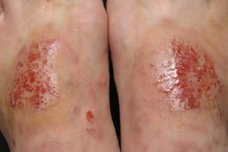 湿疹有几种类型和图片