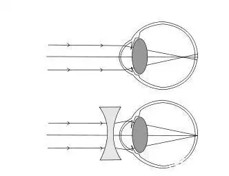 "真假"近视的区别