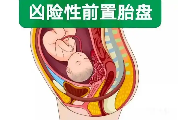 凶险性前置胎盘到底有多"凶"?30岁产妇历经"生死劫"_子宫_手术_剖宫产