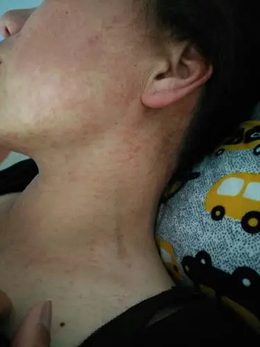 我妈妈身上起了好多大片大片的红疹,这是怎么回事啊?