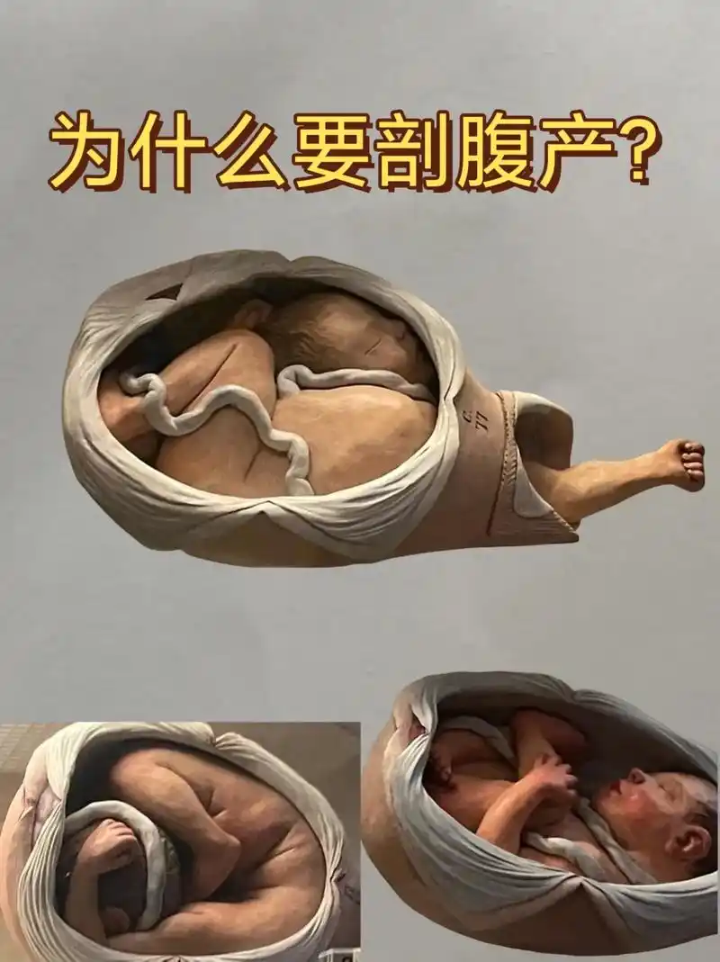 74为什么要剖腹产?