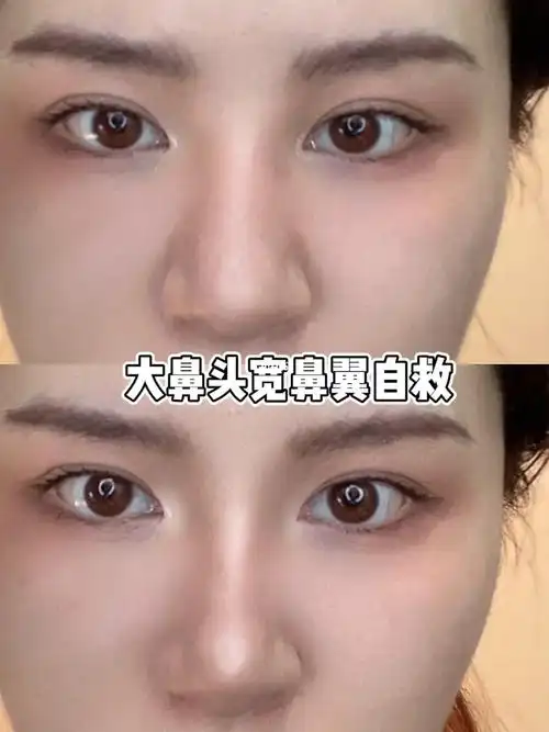 我真的悟了掌握这2点缩小鼻翼蒜头鼻