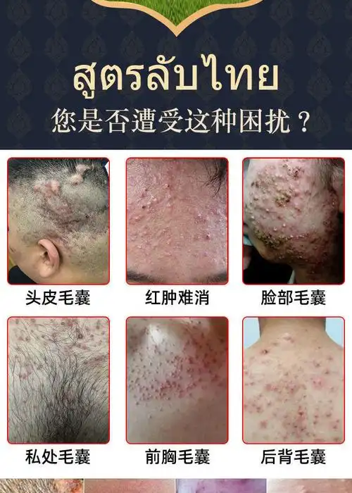 【京选优品】毛囊炎膏进口头部脸部背胸部痘痘脓包痤l疮头皮l癣脂溢性