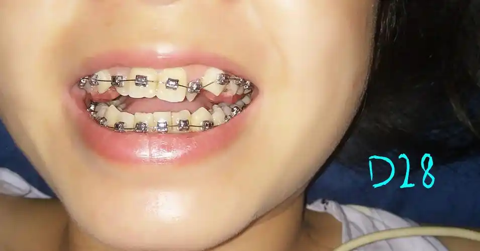 唉没啥变化就今天感觉右边那颗侧切牙有点痛有点怕突然掉了最近做梦