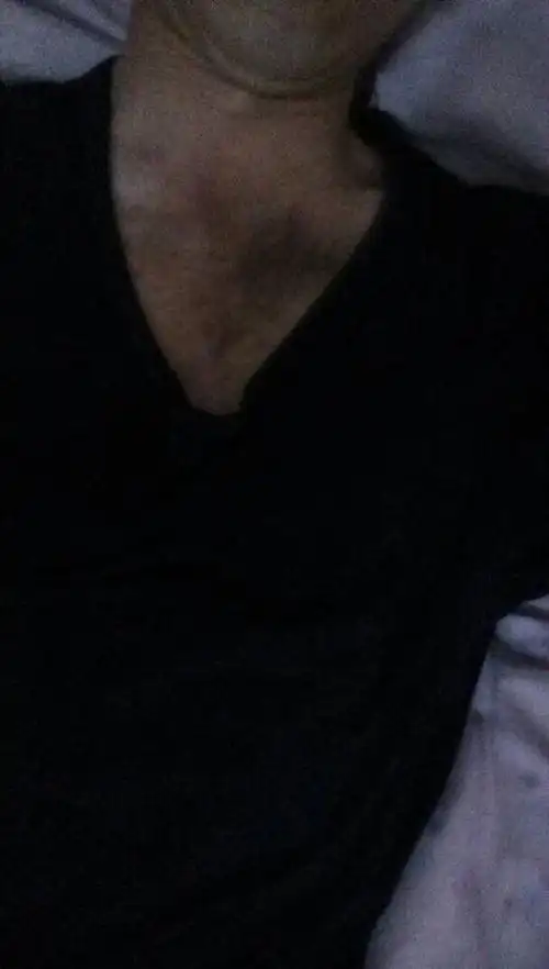 脖子下面一点有胸口上方毛,天热了想穿开领衣服都不好意思,穿衬衫和