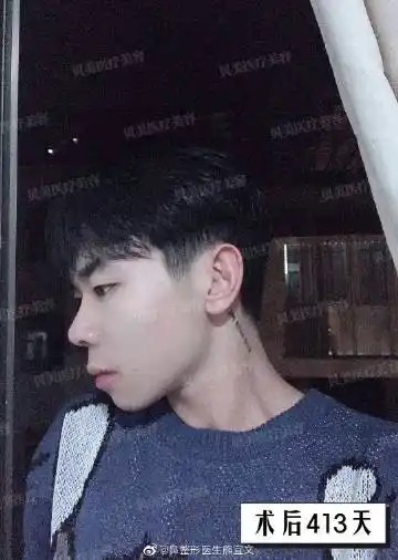 术前问题:山根低平,鼻背曲线不够挺直,小帅哥眉骨发育较好,略微有嘴凸